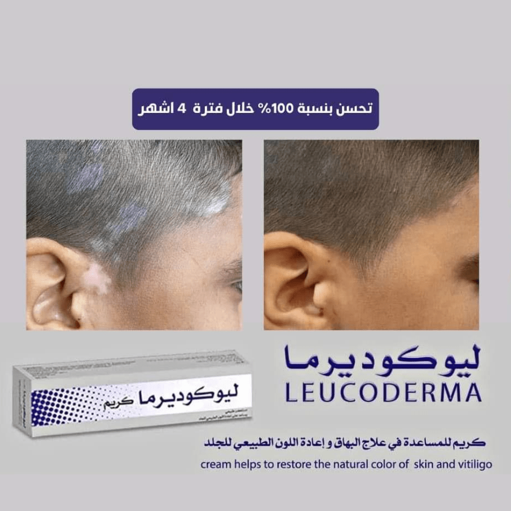 ليوكوديرما كريم طبيعي للبهاق – لاستعادة لون الجلد الطبيعي 50 مل