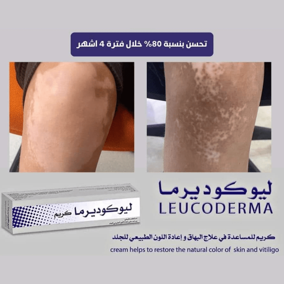 ليوكوديرما كريم طبيعي للبهاق – لاستعادة لون الجلد الطبيعي 50 مل