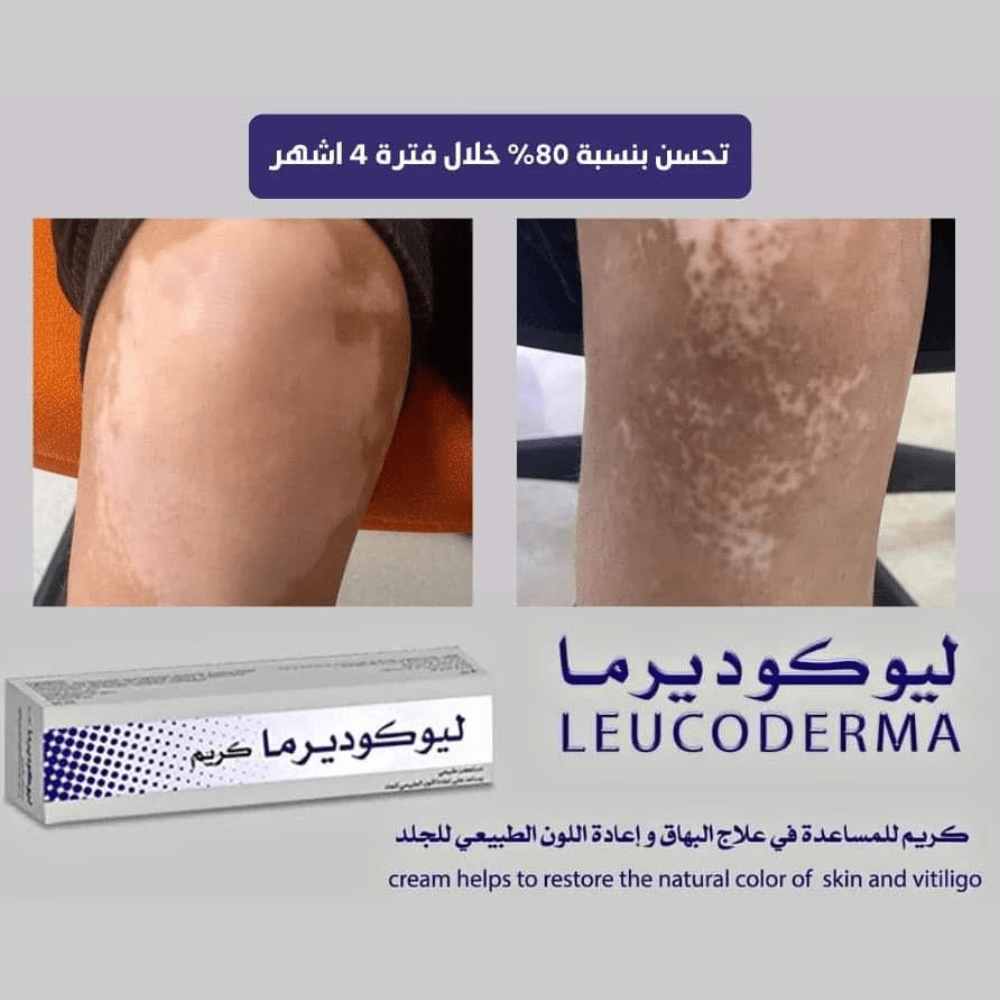 ليوكوديرما كريم طبيعي للبهاق – لاستعادة لون الجلد الطبيعي 50 مل