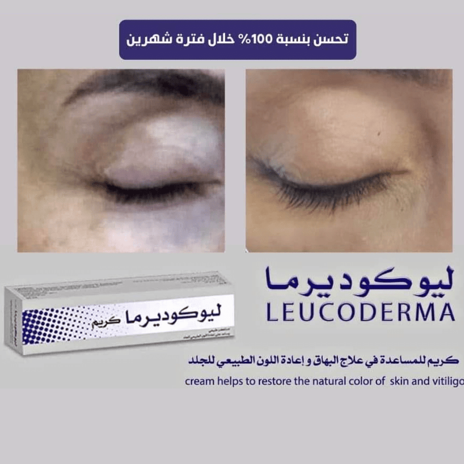 ليوكوديرما كريم طبيعي للبهاق – لاستعادة لون الجلد الطبيعي 50 مل