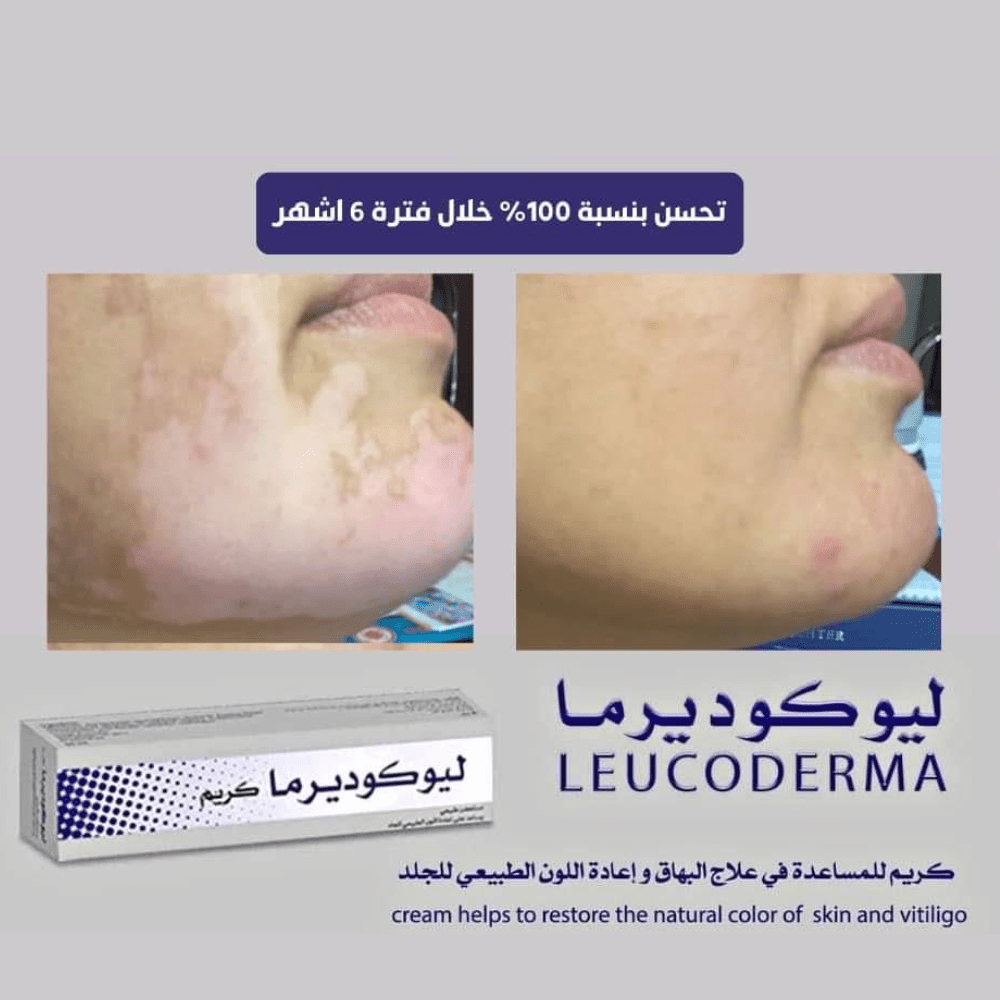 ليوكوديرما كريم طبيعي للبهاق – لاستعادة لون الجلد الطبيعي 50 مل
